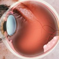 Retinoblastomas